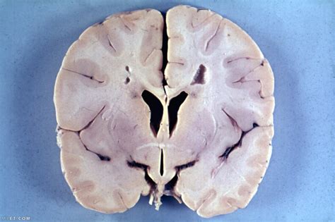 أعراض التهاب الدماغ الحاد المنتشر والفرق بينه وبين التهاب السحايا