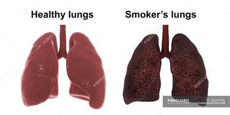 Comparison Of Healthy And Smoker Lungs Digital Illustration