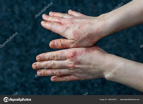Hands With Dry And Stressed Red Dyshidrotic Eczema Skin From Cleaning