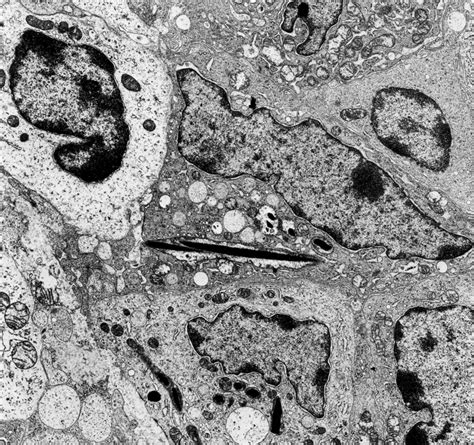 Histiocyte Like Cells With Dense Lamellar Inclusions In Mitochondria