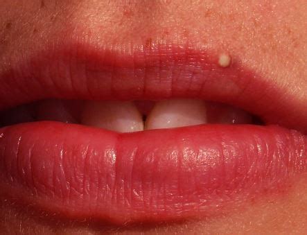 Whiteheads On Lips Around Lip Line Upper Lower Lip Get Rid Pop