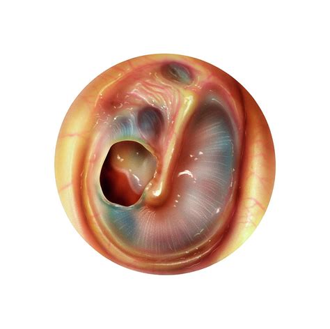 Perforated Eardrum Photograph By Bo Veislandscience Photo Library Pixels
