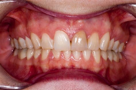 Перевод песни armed to the teeth — рейтинг: I WANT TO IMPROVE THE COLOUR OF MY FRONT TOOTH | Blue ...