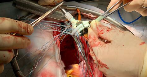Best Mitral Valve Replacement Doctors And Hospitals In India