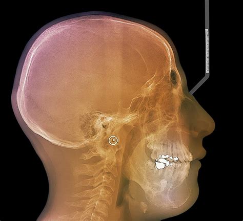 Jaw Cancer Ameloblastoma Photograph By Zephyrscience Photo Library