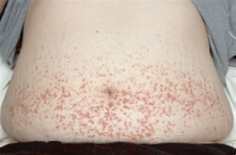 2 Purpuric Lesions On The Abdomen In A Patient With Henoch Schönlein