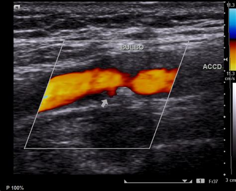 Doppler Ultrasound Scan Of Carotid Artery Stenosis Photograph By Fine