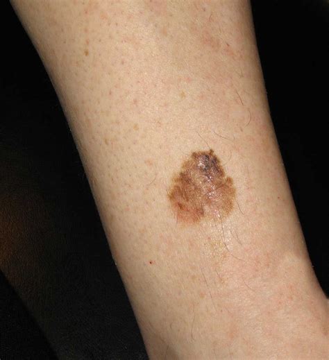 Skin Cancer Melanoma Melanoma And Non Melanoma Skin C
