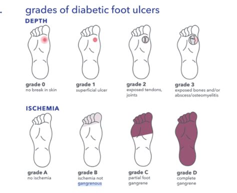 Diabetic Foot Ulcers What You Need To Know Tides Medical