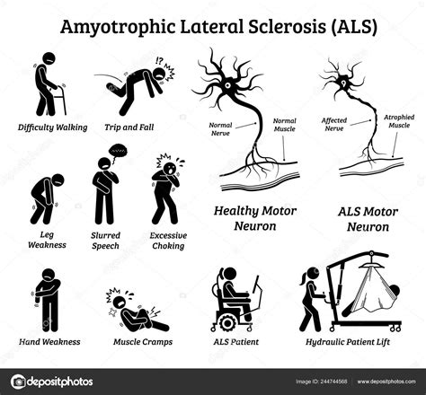 Amyotrophic Lateral Sclerosis Als Disease Signs Symptoms Illustrations