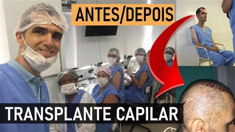 Transplante Capilar No Brasil Antes E Depois Do Trasnplante Capilar No Brasil Fut Fue Dhi
