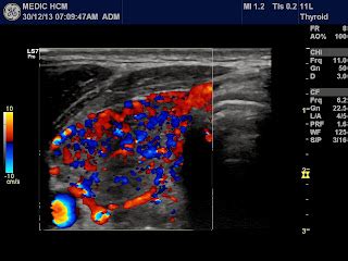 Vietnamese Medic Ultrasound Case Thyroid Toxicosis Periodic