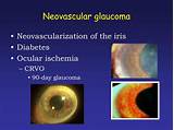Neovascular Glaucoma Treatment Pictures