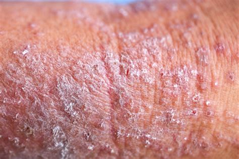 How I Treat Atopic Dermatitis With Dupilumab Dermatology Advisor