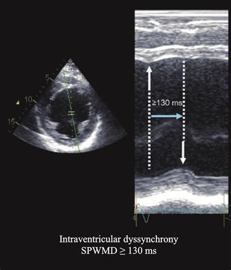 Parasternal Short Axis View At The Papillary Muscle Level Mmode Tracing
