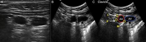 Infraclavicular Brachial Plexus Ultrasound Image Of Infraclavicular