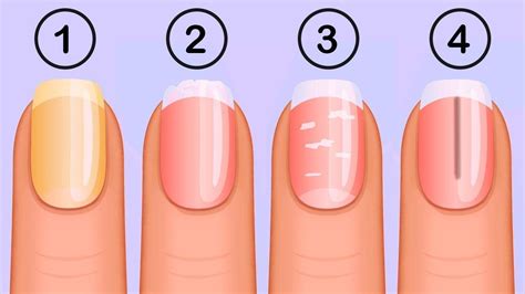 Ridged Nails White Spots On Nails Fingernail Health S