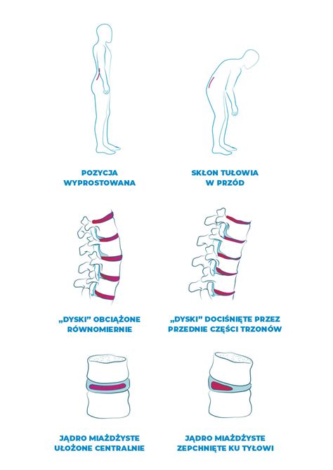 Dyskopatia Objawy Przyczyny Leczenie Onsen