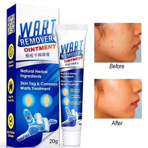 Wart Removal Cream Instant Blemish Removal Gel Effective And Safe