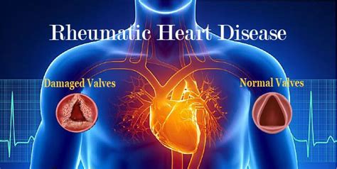 Rheumatic Heart Disease And Its Symptoms Disease Chest Discomfort