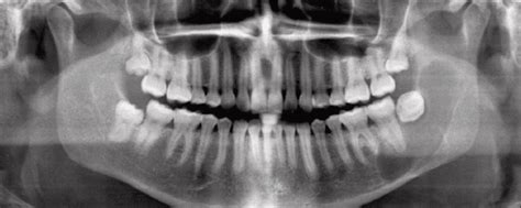 Panoramic Radiograph Showing The Radiolucent Unilocular Lesion And Its