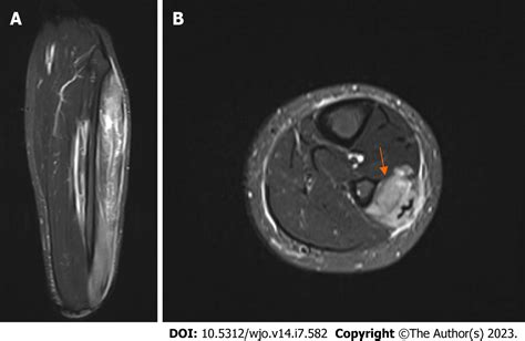 Isolated Lateral Leg Compartment Syndrome A Case Report