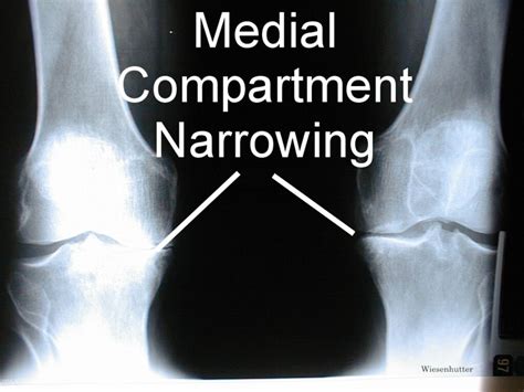 Knee Joint Space