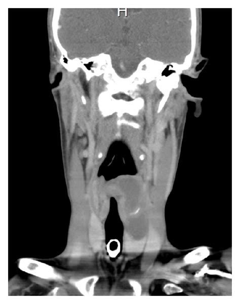 Ct Scan Head And Neck Coronal View Well Circumscribed Mass Arising
