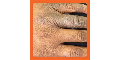 What Eczema On Black Skin Looks Like According To Dermatologists