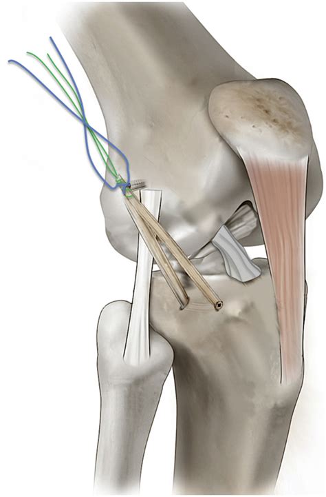 The Anterolateral Ligament Of The Knee An Updated Systematic Review Of