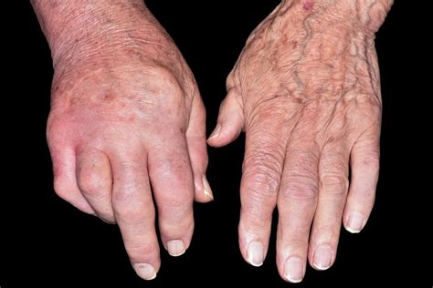 Swollen Hand In Gout Photograph By Dr P Marazzi Science Photo Library