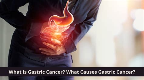 What Is Gastric Cancer What Causes Gastric Cancer Apollo Hospitals Blog
