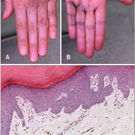A Dorsum Of The Patients Left Hand Brown To Blue Pigmentation