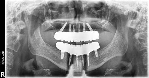 All On Dental Implants With Prettau Solid Zirconia Dental Implant
