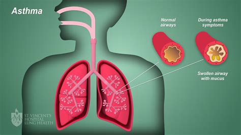 Asthma Symptoms Causes Diagnosis Treatments And Prevention