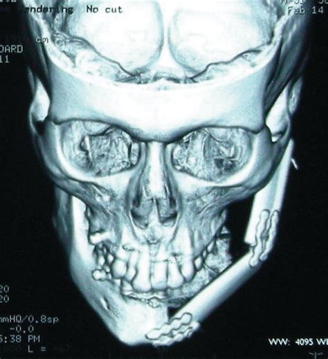 Osteosarcoma Of The Jaw Classification Diagnosis And Treatment