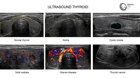 The Thyroid Quantum Medical Imaging