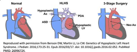 Hypoplastic Left Heart Syndrome And Its Surgical Repair Legend Hlhs