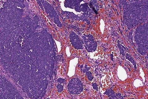 Pathology Outlines Merkel Cell Carcinoma