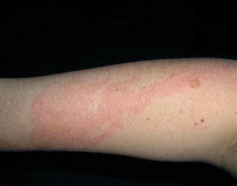 Poison Ivy Rash Pictures Treatment Symptoms Contagious Duration