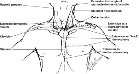 Penetrating Neck Injury Basicmedical Key