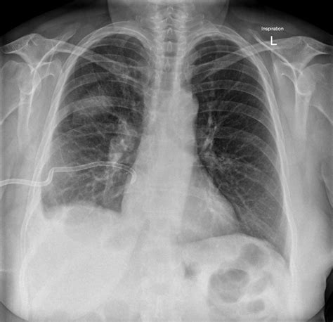 Parapneumonic Effusion Loculated Image