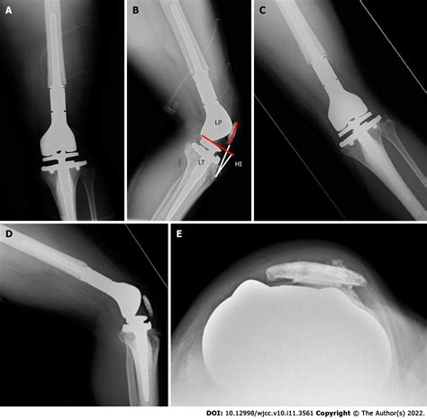 Patellar Dislocation Following Distal Femoral Replacement After Extra