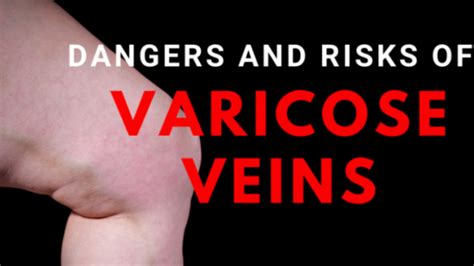 5 Hidden Dangers Of Varicose Veins Denver Vein Doc