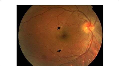 A Fundus Photograph Of The Right Eye Shows Multiple Small Retinal