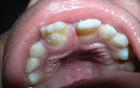What is dens invaginatus or dens in dente? | News | Dentagama