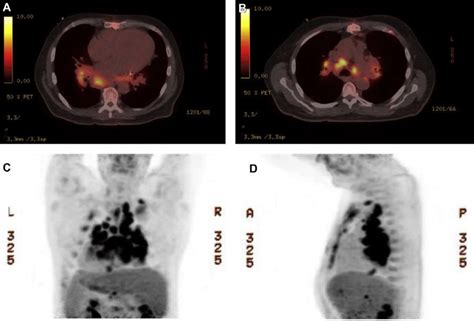 A Positron Emission Tomography With Computed Tomography Pet Ct Fused