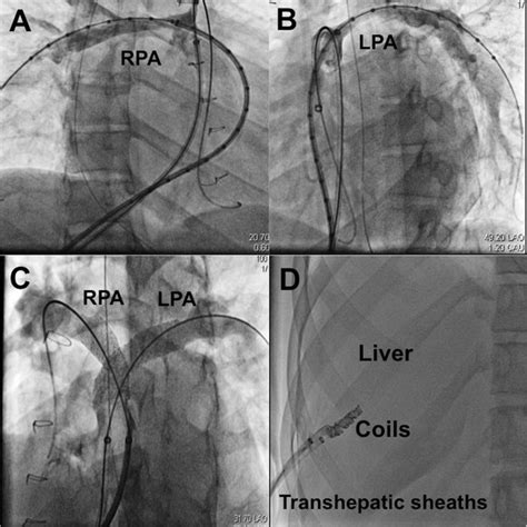 Bilateral Branch Pulmonary Artery Stenting Performed Through Two