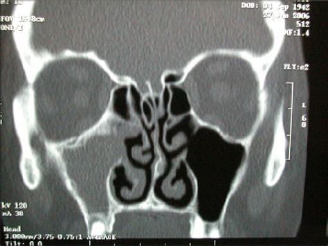 Ct Scan Showing Previously Undiagnosed Right Sided Sinus Disease