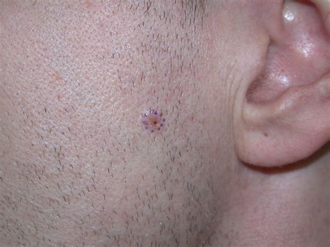 Acd A Z Of Skin Basal Cell Carcinoma Bcc